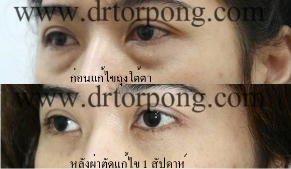ก่อนและหลังแก้ไขถุงใต้ตา 1 สัปดาห์
