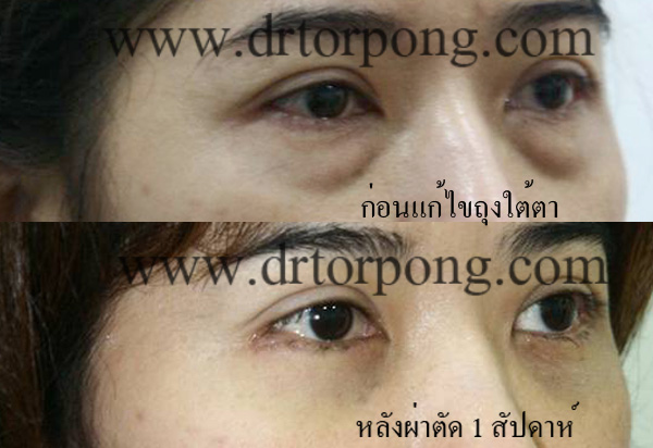 ก่อนและหลังแก้ไขถุงใต้ตา 1 สัปดาห์